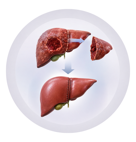 Surgery for Liver Trauma